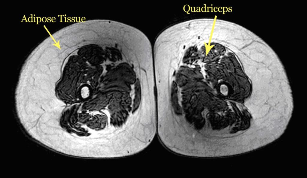 Bulk vs Cut — thigh cross-section